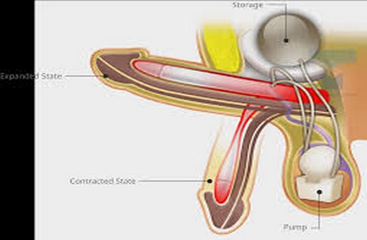 Erectile Dysfunction Surgery in India Cost Hospitals Doctor